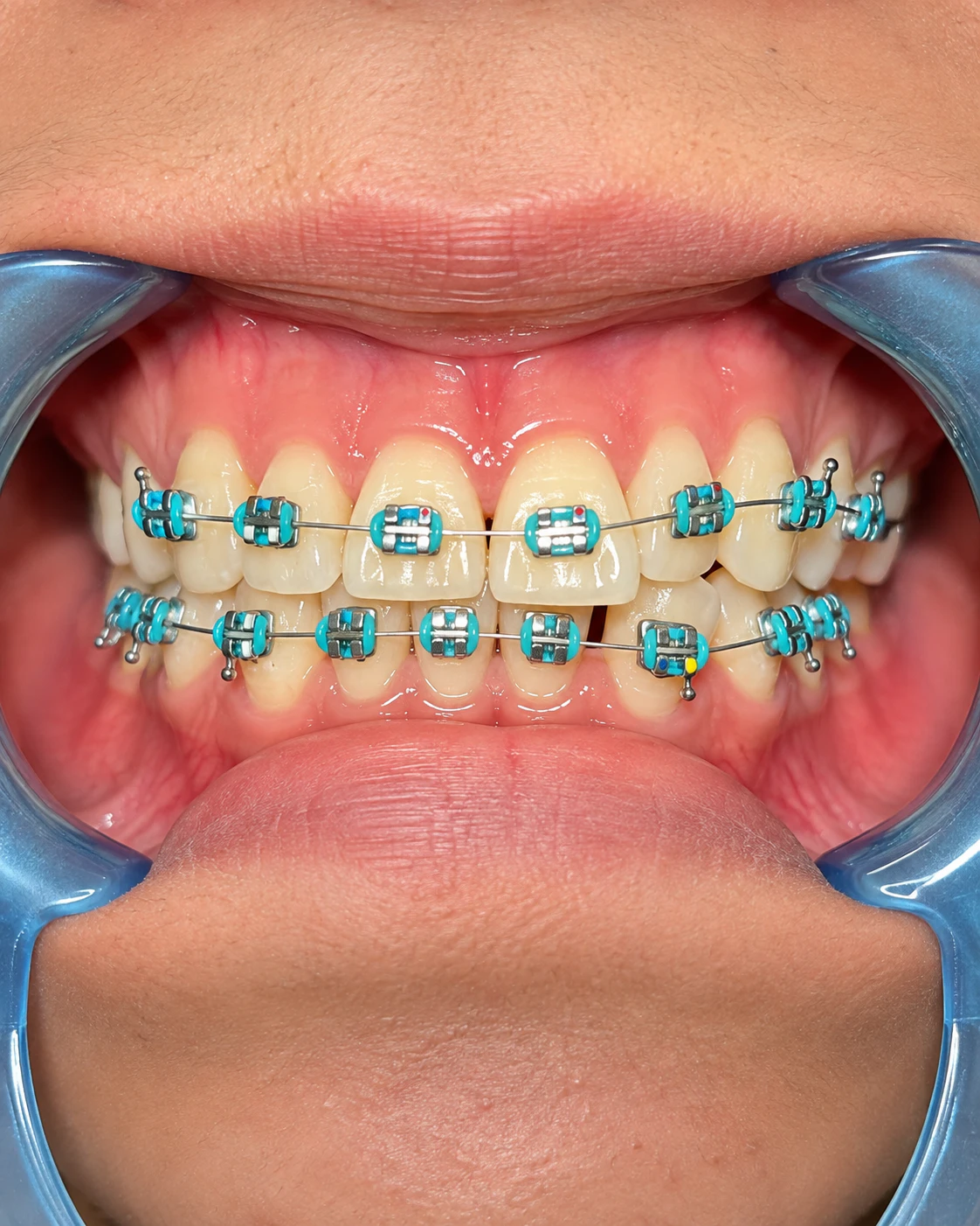 Case 03 after treatment