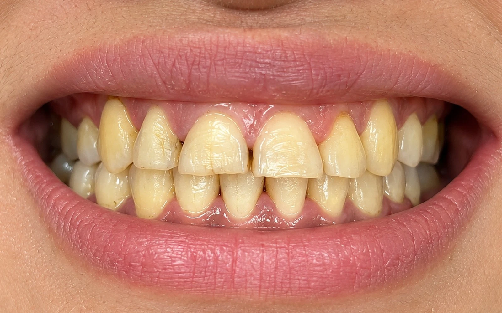 Case 02 before treatment