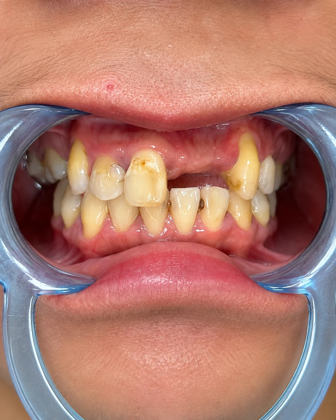Case 03 before treatment